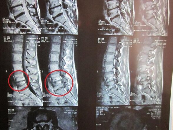 Дыягностыка шыйнага астэахандрозу