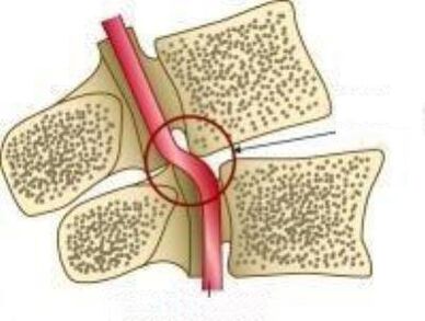 Сіндром веал -артэрыі