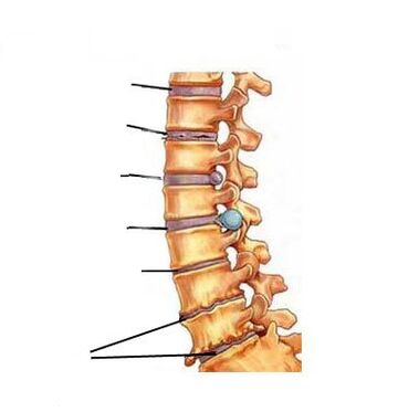 Як развіваецца астэахандроз