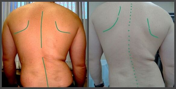 крывізна пазваночніка з астэахандроз