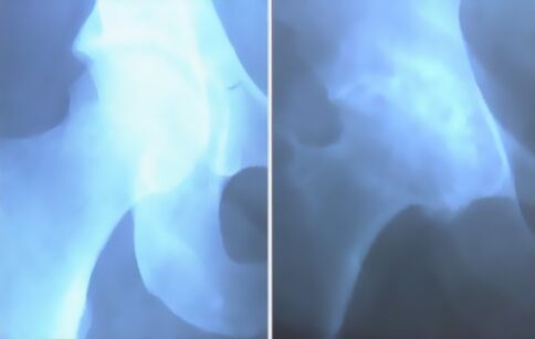 Падвешванне артрозу каленнага сустава