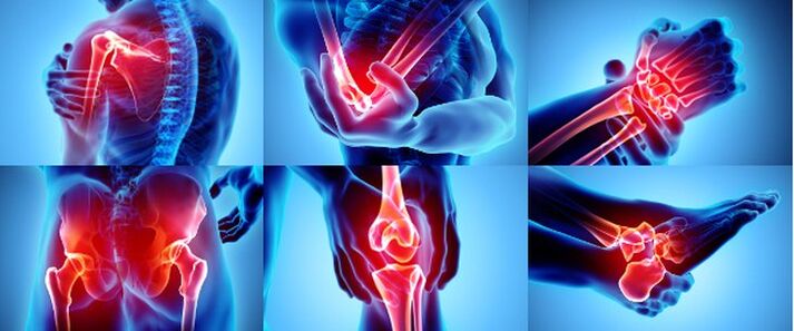 Запалёныя суставы